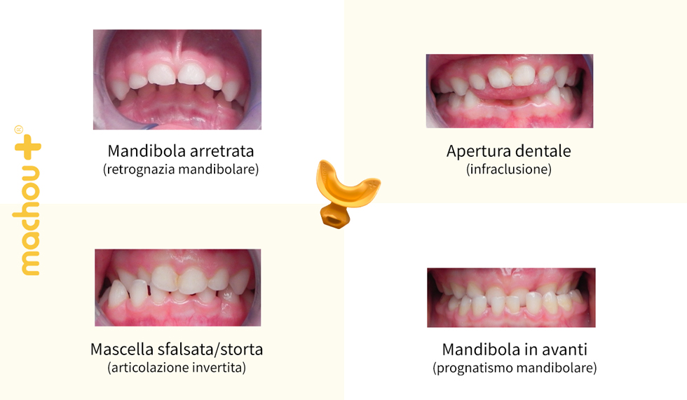 Esempi di squilibri mascellari e dentali che il bite “Machou+” può trattare e correggere nei bambini dai 2 ai 6 anni