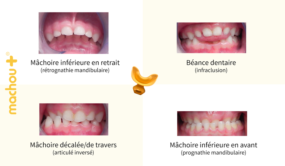 Exemples de déséquilibres de la mâchoire et dentaires que la gouttière machou+ peut soigner et rétablir chez l'enfant de 2 à 6 ans